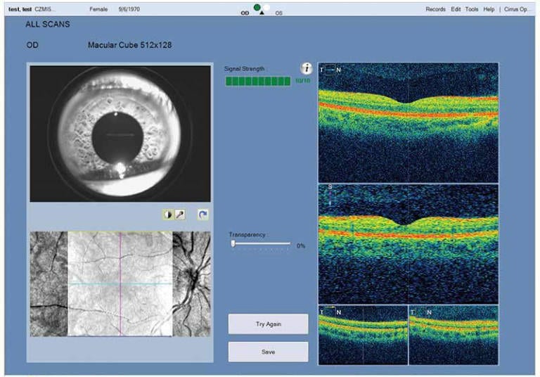 Oct Optometry Options Technology - Bellevue Vision Clinic